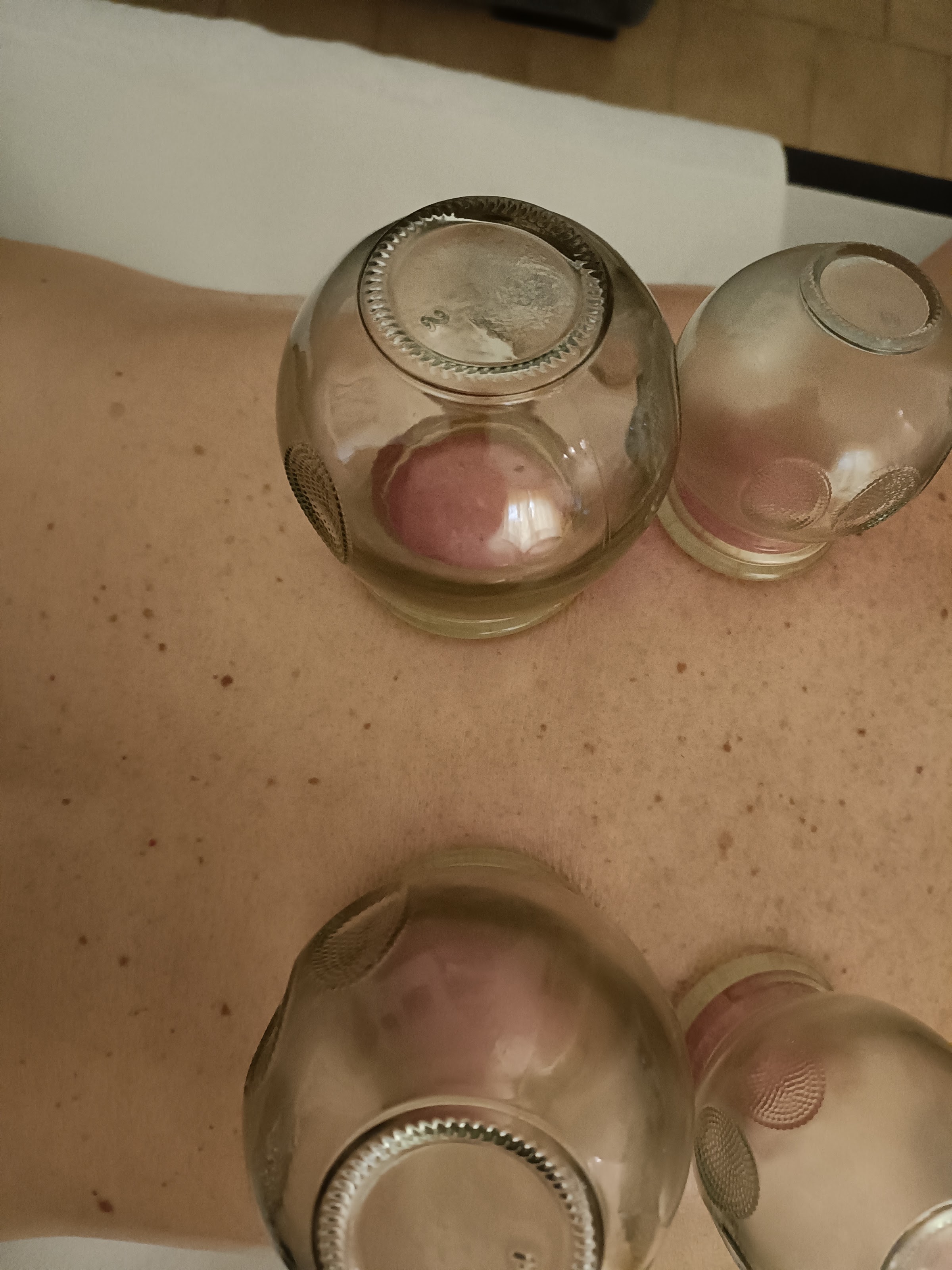 Trattamento di coppettazione presso Holistic Home